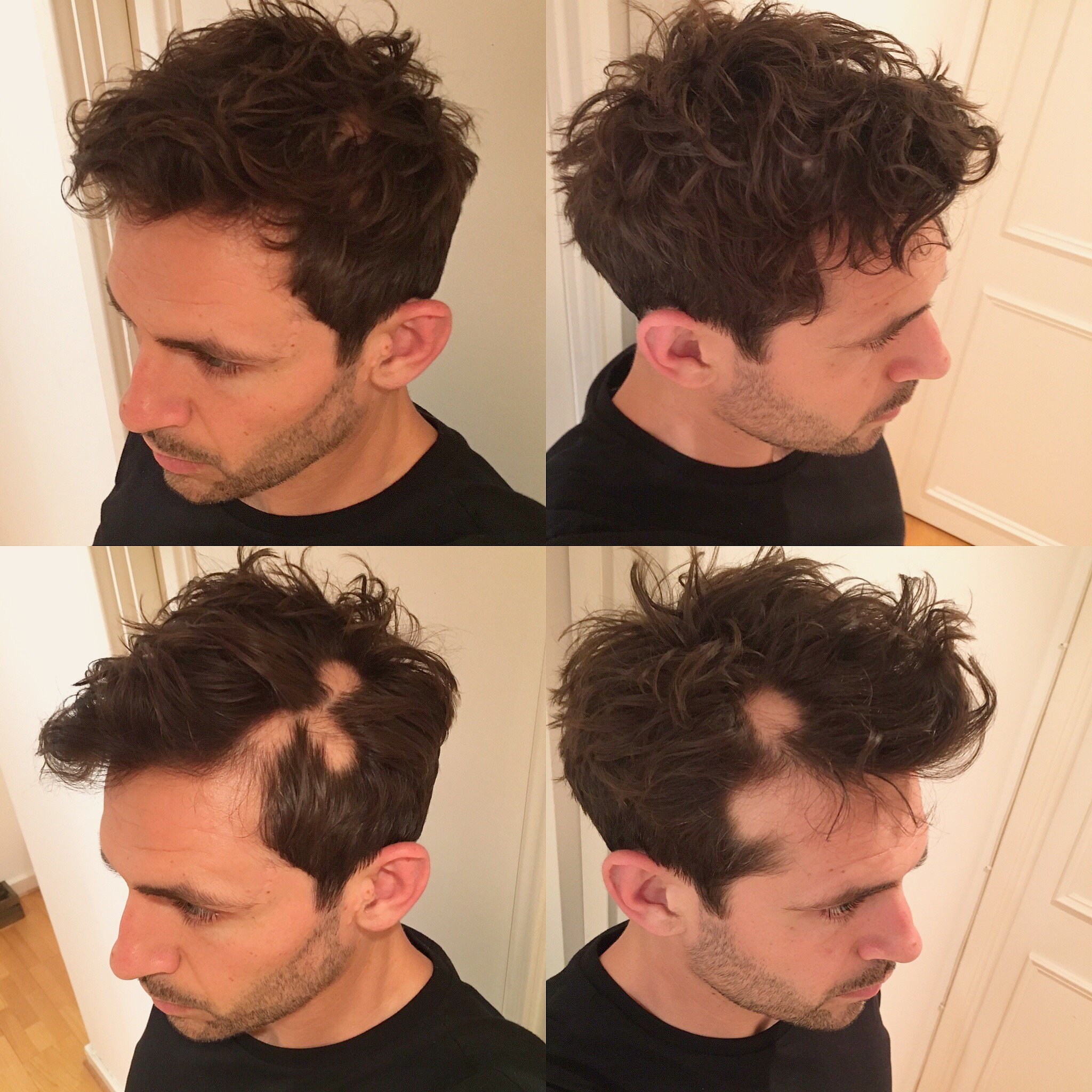 Hair patches before and after arranging hair